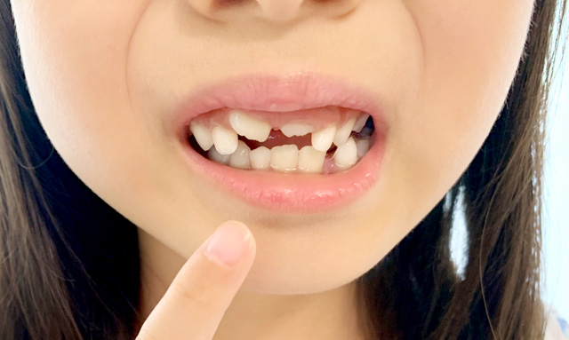 歯並びを悪くしないために