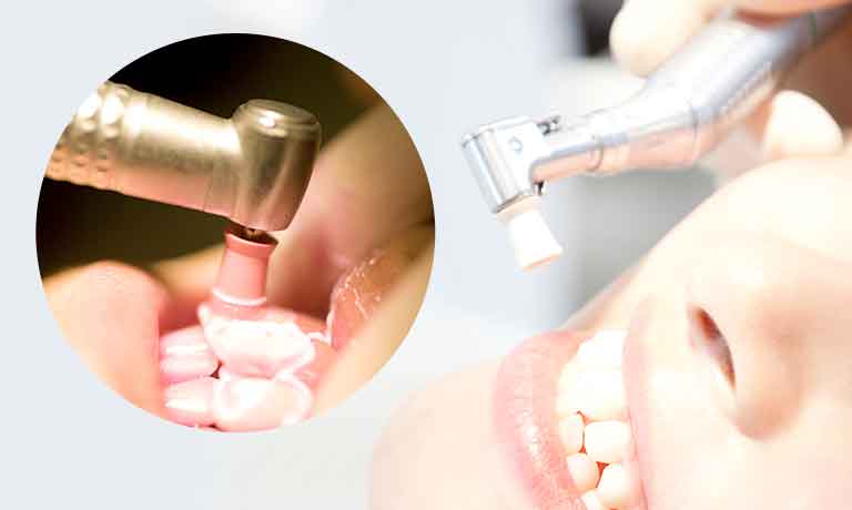 PMTC(プロによる徹底的な歯のクリーニング)
